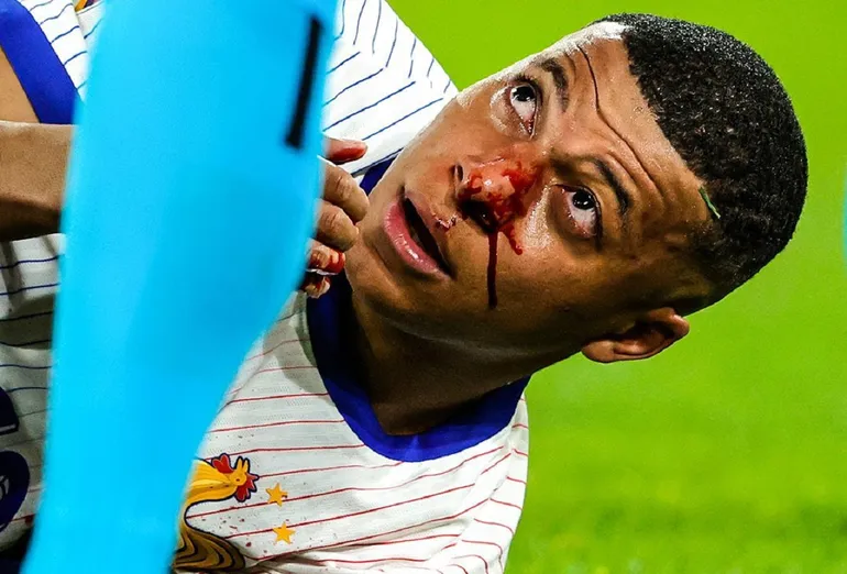 mbappe narizjpg rcg71.com